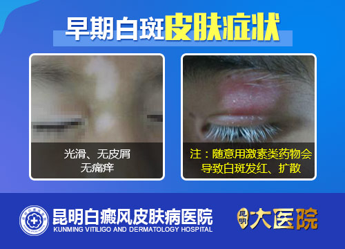 辨别皮肤白斑的早期症状