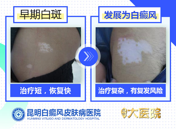 辨别皮肤白斑的早期症状