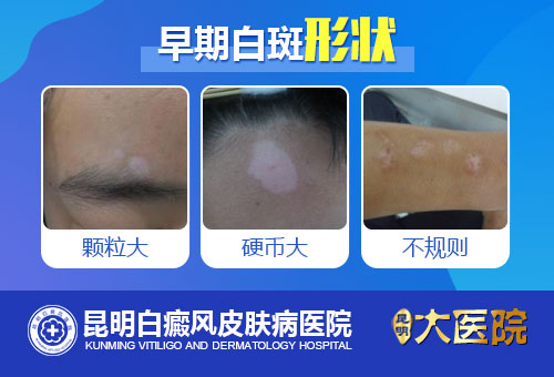 辨别皮肤白斑的早期症状